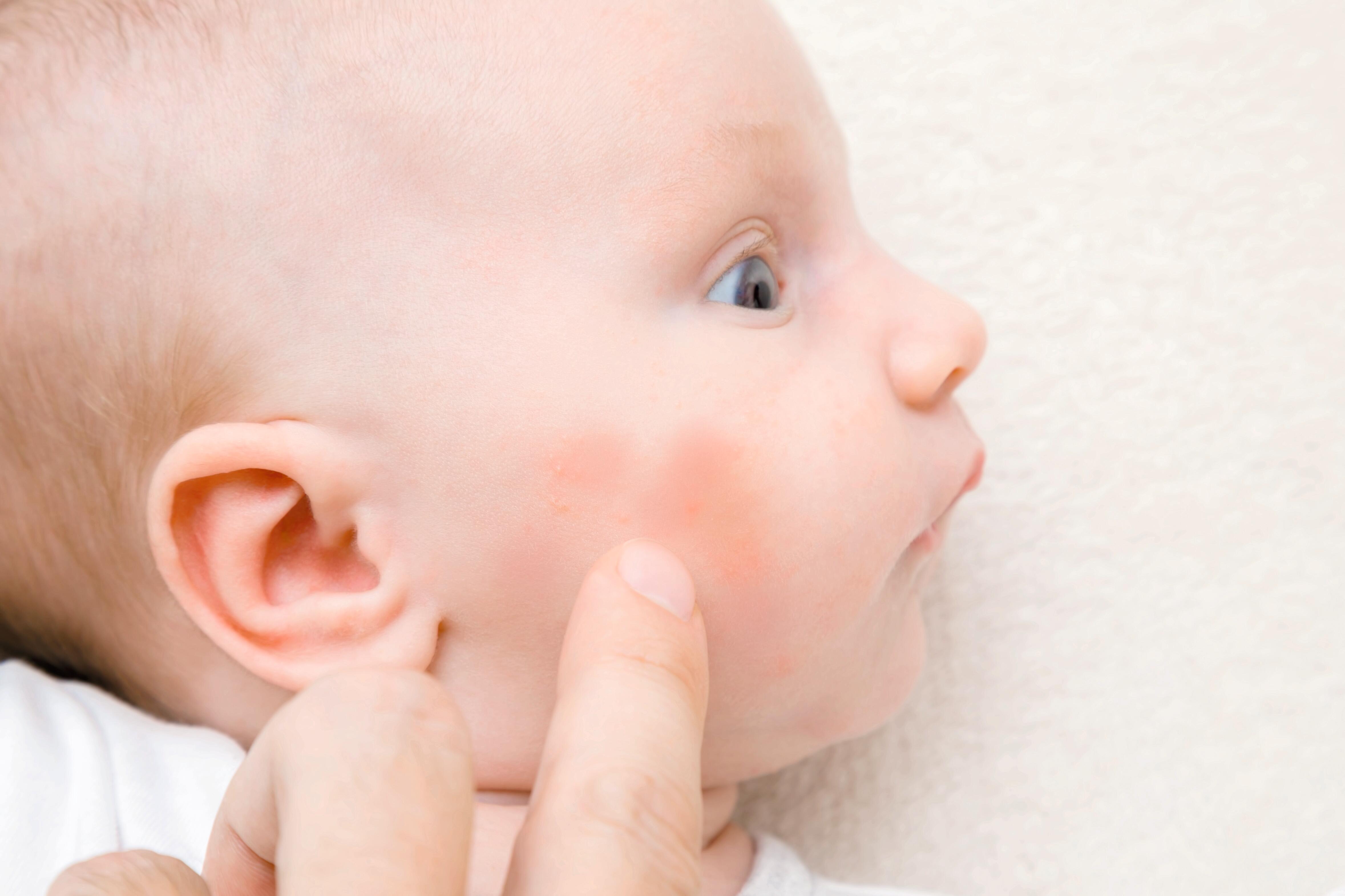Baby med rødhet på kinnet ved barneeksem.